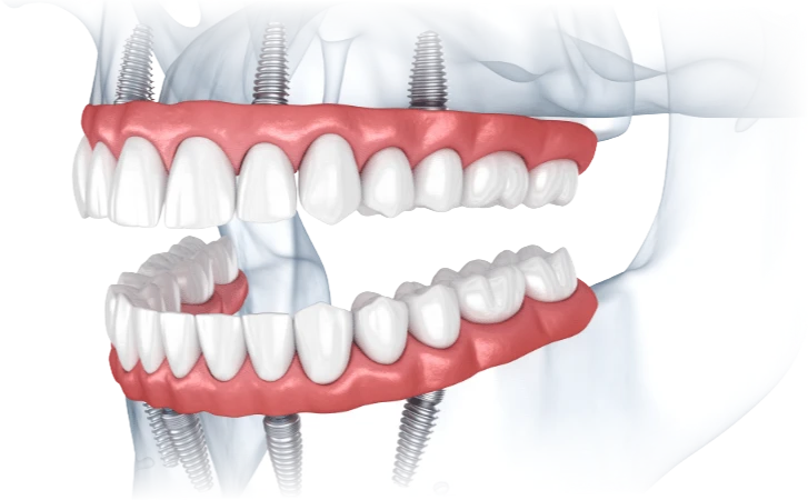 A diagram showing how permanent dental implants integrate with the jawbone.