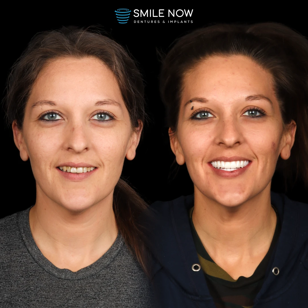 Angela before and after full mouth dental implants at Smile Now using digital smile design.